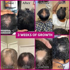 2024 Braids, Msm Hair Growth, Herbal Hair Growth Oil, Relaxed Hair Growth, Alopecia Hair Growth, Dreadlocks Hair Care, Herbal Hair Growth, Natural Hair Growth Remedies, Healthy Natural Hair Growth