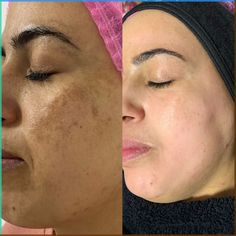 tired eyes | tired eyes relief | tired eyes remedy | tired eyes solution | tired eyes guide Tired Eyes Remedy, Eyes Guide, Facial Before And After, Skin Care Pictures, Bb Glow, Cheek Fillers, Iv Drip, Chemical Peels, Skin Photo