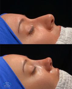 Ski Slope Nose Job, Cindy Nose Job, Nose Job Straight, Nose Job Inspiration Side Profile, Nose Jobs Inspiration, Natural Looking Nose Job, Nose Job Aesthetic Cast, Nose Job Transformation, Pretty Nose Aesthetic