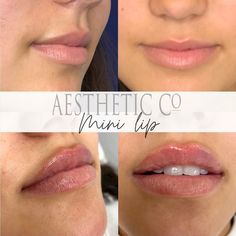 three different views of lips before and after lip fillers are applied to the lips