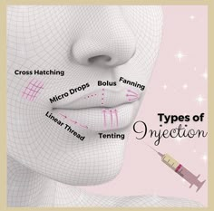 Vascular Occlusion Filler, Lip Injection Techniques, Face Injections, Dermal Fillers Lips, Facial Injections, Cosmetic Fillers