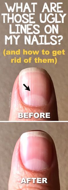 What Those Ugly Lines on Your Nails Mean About Your Health (And How to Get Rid of Them) Natural Antifungal, Types Of Nail Polish, Different Types Of Nails, Health Signs, Tongue Health, Nail Care Tips, Lines On Nails