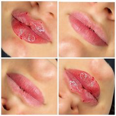 💫 Before and After - Russian lips on previously filled lips 💫 ❗️Sometimes you cannot achieve the Russian lips look until you dissolve especially if you have too much filler to the point of migration ‼️ Great for : 🤍SHAPE 🤍DEFINE 🤍LIFT 🤍STRUCTURE 💉 Procedure : Russian lips 🌡 Product : Regenovue deep 😴 Anaesthesia : Topical + Local numbing agent 😧 Pain level : Minimal 💵 Price : £250 (Topup under 6 months £150) ⏳ Time : Up to 30 mins including numbing 🤕 Recovery : Up to 2 wee... Filled Lips, Cosmetic Lip Tattoo, Filler Lip, Facial Aesthetics, Lip Tattoos, Future Career