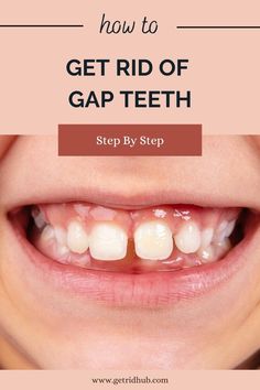 Discover treatments and options to close gap teeth. Learn about dental procedures, orthodontic treatments, and natural remedies for a confident smile. How To Close Your Gap In Your Teeth, How To Get Rid Of Gaps In Teeth, How To Close Teeth Gap At Home, Teeth Gap Filling, Gap In Teeth, Teeth Gap, Cosmetic Bonding, Dental Retainer, Pretty Teeth