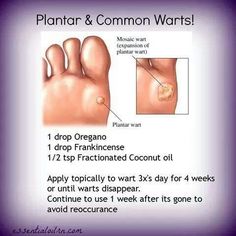 Essential oils for warts http://www.mydoterra.com/melechternach Essential Oils Warts, Terra Essential Oils, Essential Oil Remedy, Yl Oils, Oil Remedies, Oregano Oil, Yl Essential Oils, Young Living Oils