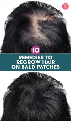 Hair Thickening Remedies, Regrow Hair Naturally, Hair Growth For Men, How To Grow Your Hair Faster, Bald Hair