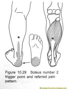 Grace's Tri-bulations: Trigger Point Plantar Fasciitis Away Now: How To Ease Pain Fast Achilles Exercises, Autogenic Training, Referred Pain, Trigger Point Massage, Trigger Point Therapy, Pressure Point, Ankle Pain