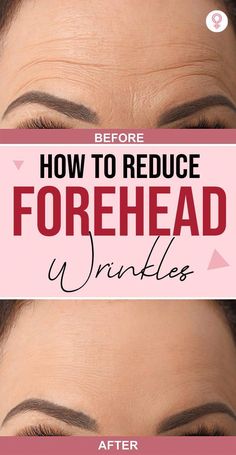 Forehead wrinkles are one of the signs of aging skin. Learn why they occur, how you can prevent them, and some natural remedies to reduce their appearance. Reduce Forehead Wrinkles, Gallbladder Removal, Wrinkle Remedies, Wrinkle Free Skin, Forehead Wrinkles, Skin Care Wrinkles, Face Wrinkles, Prevent Wrinkles, Best Anti Aging