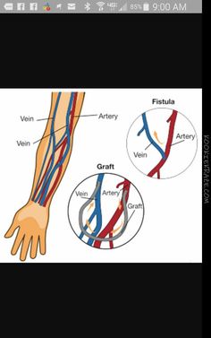 Human Circulatory System, Surgical Technician, Medical Surgical Nursing, Chronic Kidney, Human Body Anatomy