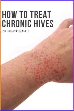 When it comes to treating hives, there are many home remedies that can help. Doctors say DO moisturize your skin, but skip the over-the-counter anti-itch creams (which can actually make the hives worse). Get Rid Of Hives Fast, How To Treat Hives, Remedies For Hives, Allergy Hives, Home Remedies For Hives, Types Of Skin Rashes, Itching Remedies, Hives Remedies, Chronic Hives