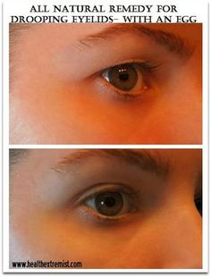 natural remedy for drooping eyelids #soin #traitement #beaute #peau #yeux #paupiere #vieillissement Drooping Eyelid, Sagging Eyelids, Drooping Eyelids, Facial Tips, Beauty Remedies, Mascara Facial, Hooded Eyes, Natural Remedy, Body Fitness