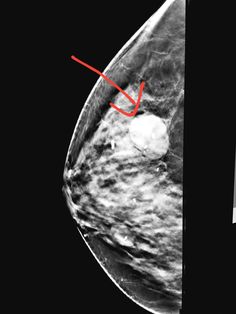 #3D #tomosynthesis #mammography shows a #mass. #radiology #radiologist #breast #breastcancer #mammogram World Radiography Day, Xray Markers Radiology, Chest Xray Interpretation, Medical Radiography, X-ray Images Radiology, Sonography Student