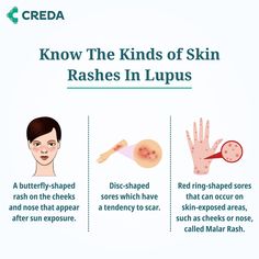 Lupus can present in various forms, including skin rashes. Three common types include- the butterfly-shaped rash on the face caused by sun exposure, disc-shaped sores that have a tendency to scar, and the red ring-shaped Malar Rash that can appear on exposed areas such as the cheeks and nose. Let's bring awareness to these brave individuals and support those affected by Lupus. Rash On Face, Face Sun, Skin Rashes, Ginger Smoothie, Red Ring, Home Beauty Tips, Red Rings, After Sun, Sun Exposure