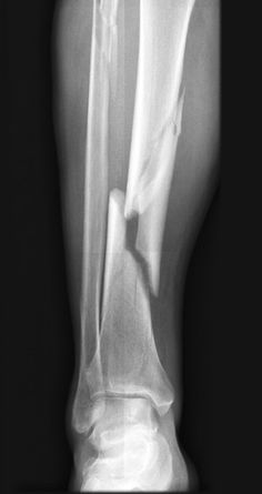 an x - ray shows the foot and ankle bones