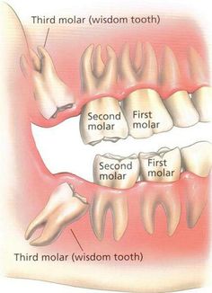 Frequently Asked Questions about Wisdom Teeth Wisdom Teeth Care Package, Pain In Back, Hygiene School, Saline Water