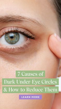 I'm often asked what causes dark under-eye circles so I want to share 7 common causes of dark under-eye circles and the solutions you can try to help reduce their appearance, naturally. #naturalremedies #naturalhealth #naturalbeauty #naturalskincare #holistichealth #wellness #skincare #eyehealth
#skin care routine #skincare product #bubble skincare Natural Dark Circle Remedy Under Eyes, Get Rid Dark Circles Under Eyes, Dark Under Eye Remedies, Dark Under Eyes How To Get Rid Of, Circle Under Eyes Remedies, How To Get Rid Of Undereye Dark Circles, Dark Circles And Wrinkles Under Eyes, Ice Under Eyes, Foods For Dark Circles Under Eyes