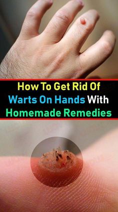 Say Goodbye to Warts: Home Remedies That Actually Work! #Warts #HomeRemedies #SkinCare #DIYTreatment #Wellness #HealthAndBeauty Wart Remedies, Wart On Finger, Warts On Hands, Warts On Face, Home Remedies For Warts, Warts Remedy, Remove Warts, Skin Growths, Get Rid Of Warts