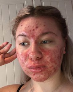 Abigail Collins, 19, has suffered with spots since the age of 10 Cystic Acne Remedies, Blind Pimple, Forehead Acne, Pimples Under The Skin, Bad Acne, Acne Overnight, Flaking Skin, Natural Acne Remedies, Severe Acne