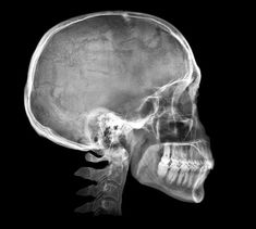 an x - ray image of the head and neck of a human skeleton in black and white