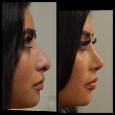 Droopy Tip Nose Rhinoplasty, Round Face Nose Job, Nose Job Front Profile, Nose Job Inspiration Front View, Nose Job Inspo Front View, Nose Job Front View, Bulbous Nose Rhinoplasty Before After, Perfect Nose Front View