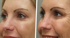 20 units of botox before and after 3 Botox Results, Stomach Exercises, Nasolabial Folds, Smile Lines, Workout For Flat Stomach, Botox Injections, Facial Rejuvenation, Cosmetic Treatments