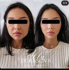 Round Face Surgery, Jawline Black Woman, Face Symmetry Fillers, Face Lipo Before And After, Masseter Botox Injection Before And After, Facial Contouring Fillers, Face Contouring Fillers, Face Balancing Fillers, Cheek Surgery