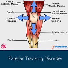 The Ultimate Guide To Patellar Tracking Disorder Swollen Knee, Wellness Space, Sports Therapy, Exercise Physiology, Kinesiology Taping