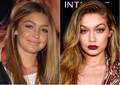 Gigi Hadid Nose Job Before And After, Celebrity Rhinoplasty, Gigi Hadid Before, Celebrity Surgery, Plastic Surgery Photos, Celebrity Plastic Surgery, The Kardashians, Nose Job, Tummy Tucks