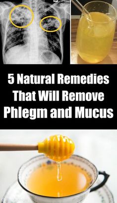 Best Cough Remedy, Baby Cough Remedies, Homemade Cough Remedies, Cold And Cough Remedies, Home Remedy For Cough, Cold Sores Remedies, Natural Sleep Remedies, Natural Cold Remedies, Natural Cough Remedies