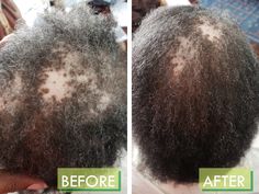 Don't give up on growing your own great hair. Now with our RENEWAL+ Growth Complex. Our unique blend of herbal plant ingredients promote healthier, thicker, and more lush hair after only 30 days of use. Just look at our many before and after pictures. Field trials have shown great results on those who advised that they suffer from long term post partum alopecia, alopecia areata, and early female pattern baldness. Use along with our Heal & Grow Botanical Oil for great results. Results may vary. ? Hair Growth Regimen, Growing Facial Hair, Hair Regrowth Women, Lush Hair, Alopecia Hairstyles, Female Pattern Baldness, Hair Regrowth Treatments, Herbal Plants, Hairstyles For Teens