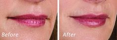 https://flic.kr/p/DHwUuL | Volbella Lip Filler | Volbella Facial Filler Dr. John L. Burns, Jr., MD Board Certified Plastic Surgeon President, Dallas Plastic Surgery Institute