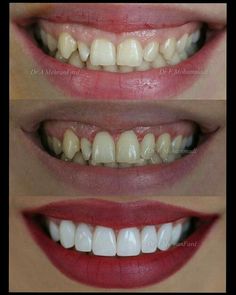 Dental Ceramics, Dental Images, Dental Aesthetics, Dental Cavities, Facial Contouring