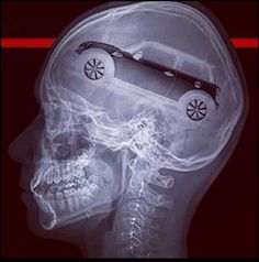 an x - ray image of a car in the head