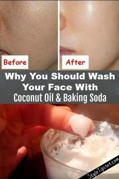 Baking Soda and Coconut Oil Face Mask Coconut Oil Face Wash, Acne Face Mask Recipe, Oil Face Wash, Acne Scar Mask, Blackhead Remover Diy, Coconut Oil Face Mask, Coconut Oil Face, Coconut Oil And Baking Soda, Baking With Coconut Oil