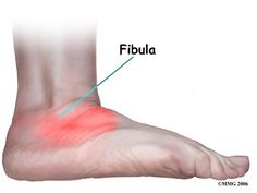 Tarsal Coalition, Tibial Plateau Fracture Exercises, Calcaneus Fracture, Insertional Achilles Tendinopathy, Ankle Ligaments, Anterior Cruciate Ligament, Myofascial Release, Muscle Spasms, Leg Muscles