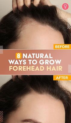 Hair loss on the forehead, at the hairline, can be scary. In this article, we discuss how to prevent that and share other hair growth remedies. Click here. Grow Baby Hair, Forehead Hair, Underarm Hair Removal, Hair Growing Tips, Healthy Quotes, Hair Remedies For Growth, Regrow Hair, Hair Control