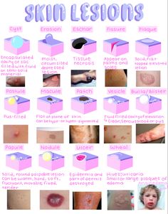 the different types of skin and how they are used to treat for them in this case