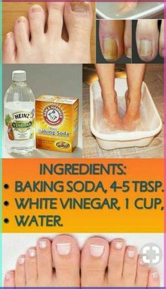 ➡️ SEGUIR LEYENDO ➡️ 🔴 Toenail Fungus Remedies, Skinnytaste Recipes, Toenail Fungus, Skincare Video, Nail Fungus, Homemade Remedies, Simple Home, White Vinegar, Natural Home Remedies