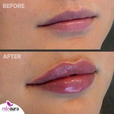 Lip Fillers Juvederm, 1ml Lip Filler, Dermal Fillers Lips, Fuller Lips Naturally, Plumper Lips, Lip Maximizer, Permanente Make-up