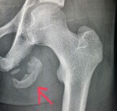 #Hip #xray shows a #fracture (#avulsion) of #bone from #tear of the #hamstring #tendon in a #patient with #pain from #sports #injury. #radiologist #radiology #trauma Hip Xray, Torn Hamstring, Nuclear Medicine, Xray Tech, Lower Limb, Rad Tech, Sports Injury, Work Memes