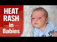 Are you worried about the red spot or small bumps on your baby's skin? This could be because of heat rash. Watch this video to learn about the symptoms, caus... Heat Rash Remedy For Babies, Skin Rash On Face, Baby Heat Rash, Prickly Heat Rash, Baby Skin Rash, Prickly Heat