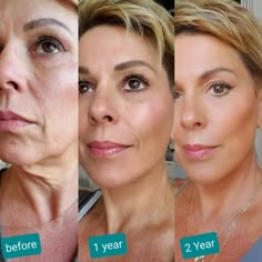 Neck Lift Surgery, Local Anesthesia, Green Tea Face, Facial Contouring, Neck Lift, Facial Plastic, Laser Skin, Housewives Of Beverly Hills