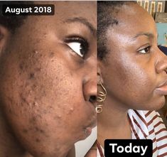 Perfect Derma Peel, Esthetician Marketing, Health Poster, Stop Scrolling, Medical Aesthetic, Transformation Tuesday, Glowing Complexion, Esthetician