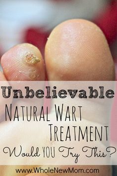 Got a wart that needs to go? This Natural Wart Remedy is the cheapest one around and it really works! I tried several natural wart remedies, but this worked the best. Would YOU try this? Wart Remedies, Natural Wart Remedies, Get Rid Of Warts, Diy Kosmetik, Cold Sores Remedies, Natural Sleep Remedies, Natural Cold Remedies, Cold Home Remedies