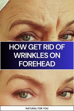 Discover natural ways to smooth forehead wrinkles using ingredients like aloe vera, coconut oil, and facial exercises. These simple, non-invasive methods can help reduce fine lines and restore a youthful, smooth complexion. Diy Facial Moisturizer, Diy Anti Aging, Eliminate Wrinkles