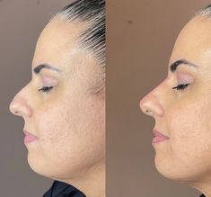 Nosejob Rhinoplasty Before After, Dorsal Hump Rhinoplasty, Revision Rhinoplasty Before After, Droopy Tip Nose Rhinoplasty, Rhinoplasty Bulbous Tip