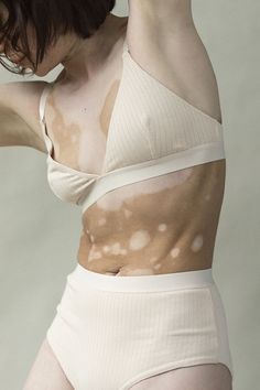 a woman with sunburn spots on her body