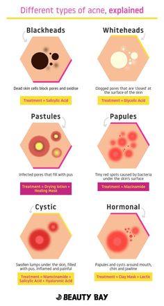 Different Types Of Acne, Skincare For Combination Skin, Types Of Acne, Clear Skin Tips, Image Skincare, Oily Skin Care, Skin Care Routine Steps, Beauty Bay, Skin Care Solutions