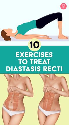 the top 10 exercises to treat diastasis recti