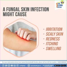 A fungal infection, also called mycosis, is a skin disease caused by fungus. They live in the dirt, plants, household surfaces, and on your skin. Causes Of Fungal Infection, Toe Nail Fungal Infection, Skin Fungus, Fungal Infection Skin, Nail Infection, Working Mom Tips, Scaly Skin, Fungal Nail, Skin Redness